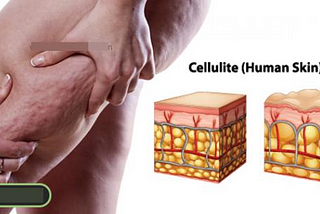 Fillers for Cellulite Before and After (Can Fillers get rid of Cellulite?)