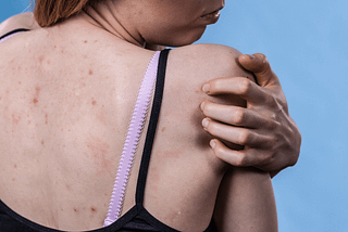 What is Contact Dermatitis?