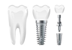 Can Dental Implants Last a Lifetime?