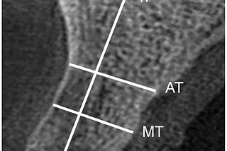 Microscopic and Tomographic Analyses of Alveoli Repaired by Three Alveolar Preservation Techniques…