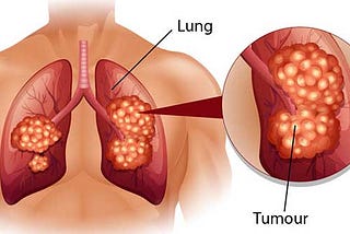 Where lungs cancer begins