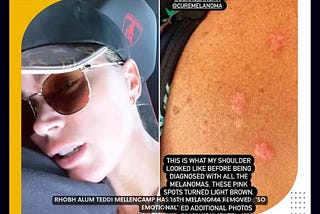 RHOBH Alum Teddi Mellencamp Has 16th Melanoma Removed: ‘So Emotional’