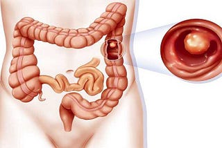 سرطان روده بزرگ یا کولون، علت، علائم و نشانه ها، روش های پیشگیری و درمان