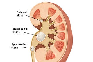 The silent buildup that leads to kidney stones