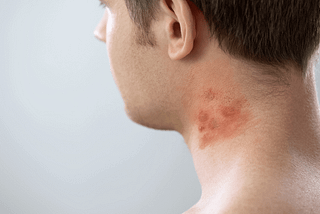 What is Dyshidrotic Dermatitis?