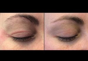 Eczema Around Eyes Causing Wrinkles/ How To Treat