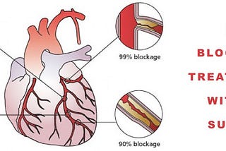 EECP Treatment For Heart Blockage Without Surgery