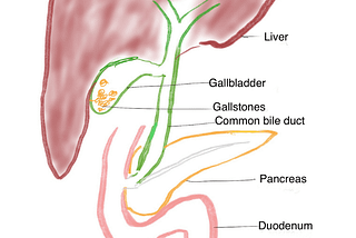 What if gallstones are left untreated?