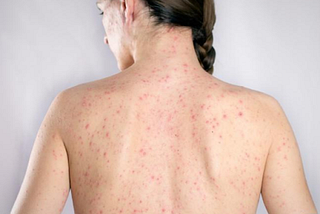 Shingles Treatment Understanding and Managing the Painful Rash