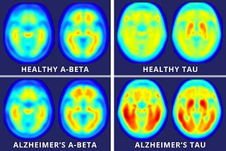 Curing Alzheimer’s…in mice? Ft. Stem Cells