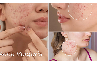 An In-depth Understanding of Acne Vulgaris: Essential Practices, Presentations, Treatments and…