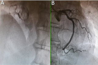 Cardiac Arrest with Multiple Coronary Occlusions….!!!