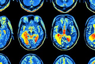 Diagnosing ADHD Using Brain Biomarkers and Machine Learning