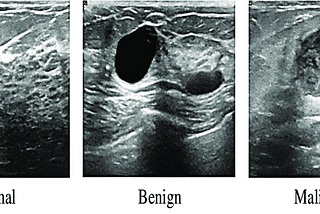 AI Bases Breast Cancer Detection Using Ultrasound Images | By Shoeb Ahmad