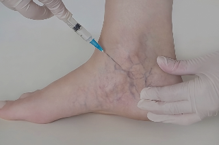 Essential Sclerotherapy Training: Master Vein Treatments