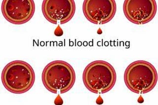 Hemophilia: