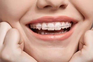 The Advantages of Clear Braces for Adults in Boca Raton