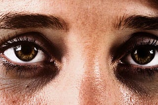 Do you have dark circles??? Here is how to get rid of it