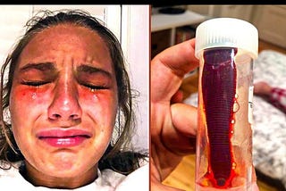 Girl Has Intense Itch Inside Nose – Visits Doctors And Makes Terrifying Discovery