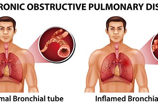 Bronchitis