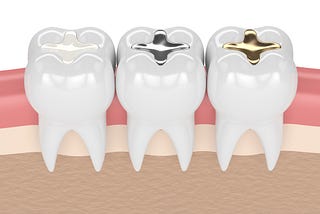 Cavity Fillings