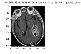 Brain Tumor Segmentation Using Deep Learning