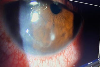 Cornea Ulceration Part 1: See with 16% Right-Eye Sharpness