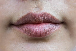 8 simple tips to get rid of chapped/dry lips.