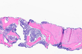Blastoid High Grade B-Cell Lymphoma