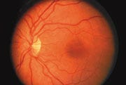 Diabetic Retinopathy Detection