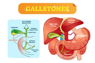 The various signs and symptoms of gallstones