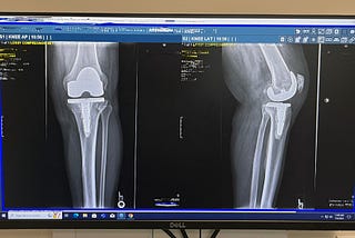 How Knee Replacement Reminded Me that We All Get Older, But Being Old is a Choice