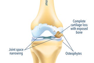 Reclaim Your Freedom with Tailored Osteoarthritis Treatments