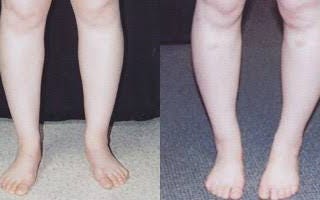 Exercises to Get Rid of Cankles at Home without getting much stress but fun so you kick out Cankles…