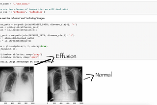 Spotting Anomalies in Chest X Ray Scans using Deep Learning