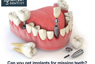 Dental Implants: Can you get implants for missing teeth?