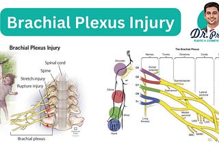 Navigating Brachial Plexus Care: Comprehensive Insights with Dr. Prince