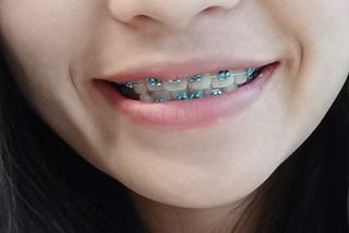 เริ่มต้นจัดฟัน (Braces)ต้องเตรียมอะไร