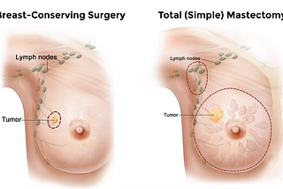 Using KL divergence and Mutual Information as a hybrid feature selection method in breast cancer…