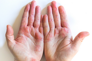 Eczema & Dishwashing: Solution For Managing Sensitive Skin