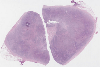 Classic Hodgkin Lymphoma, Nodular Sclerosis Variant