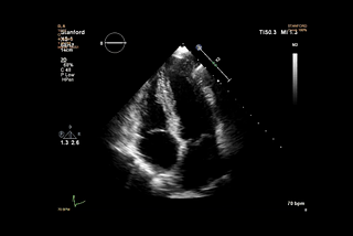 Finding Diagnosis in a Sea of Transcripts: The Case of a Hypertrophic Cardiomyopathy Patient