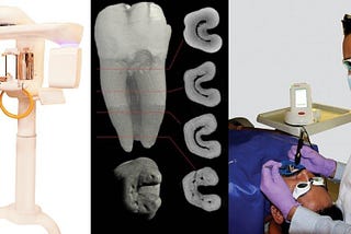 Root Canal Treatment in Gurgaon | 32 Dental Solutions