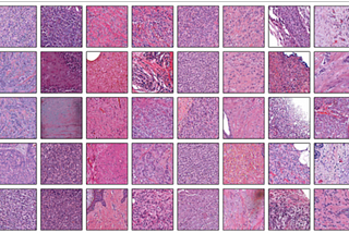 Computer Vision and Identifying Patterns in Breast Cancer