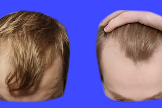 How to Fix Your Thinning Hair (Men Only)