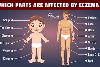 Atopic dermatitis treatment in homeopathy