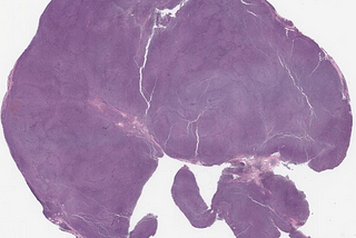 Mantle Cell Lymphoma, Negative for Cyclin-D1 Stain