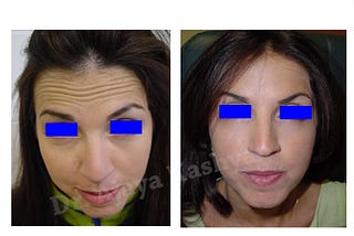 Excellent Quality with Best Cost of Botox Treatment in Aya Nagar, Delhi