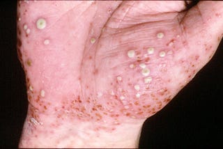 Pustular Psoriasis