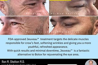 Discover Jeuveau: A New Solution for Crow’s Feet